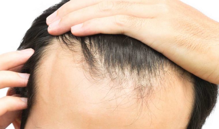 Male Hair Loss Prevention Treatments – An Overview